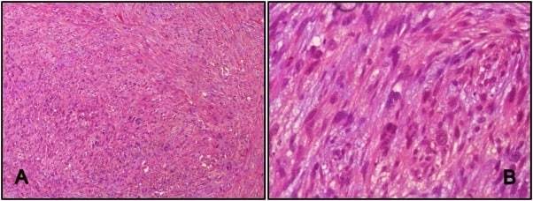 Detectan inusual sarcoma en la vena safena en paciente puertorriqueña con masa en el muslo derecho 
