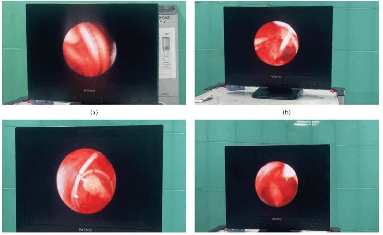 Stent ureteral anudado e incrustado tras retención prolongada en paciente con litiasis e hidronefrosis 
