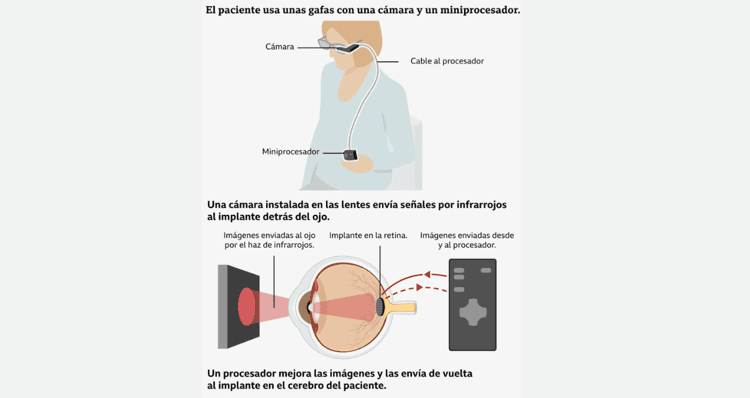 Desarrollan implante fotovoltaico que devuelve la capacidad de leer a personas con degeneración macular 