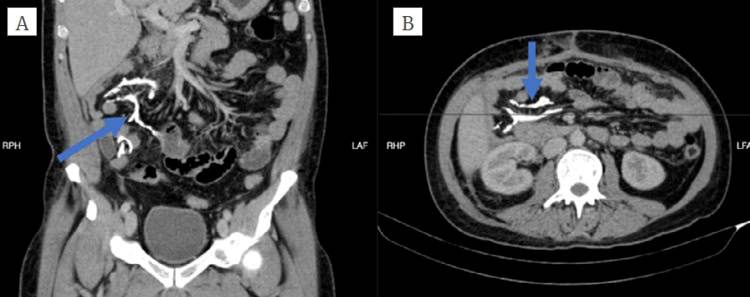 Detectan formación anormal de hueso en el mesenterio de un paciente con ileostomía durante una tomografía 