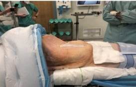 Hallan quiste ovárico de 54 cm en mujer de 71 años con histerectomía previa 