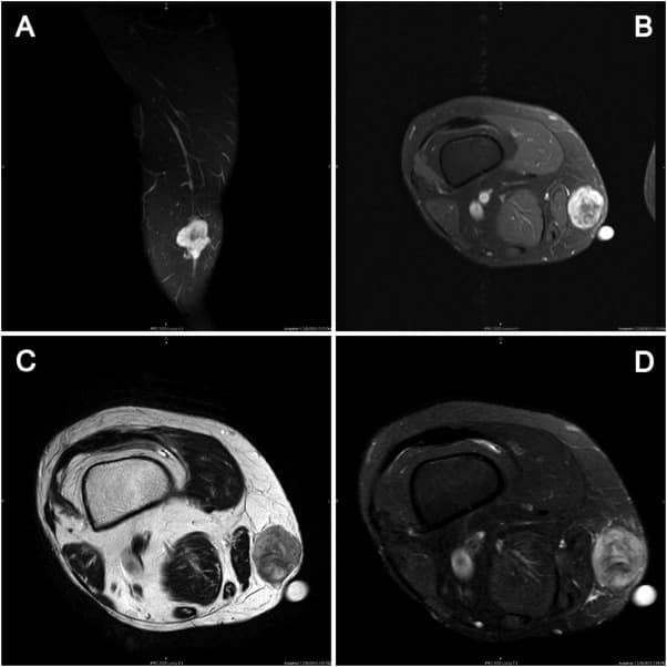 Detectan inusual sarcoma en la vena safena en paciente puertorriqueña con masa en el muslo derecho 