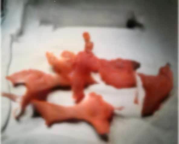 Detectan formación anormal de hueso en el mesenterio de un paciente con ileostomía durante una tomografía 