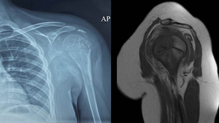 Tumor óseo invade húmero de paciente pediátrico de 10 años en Puerto Rico