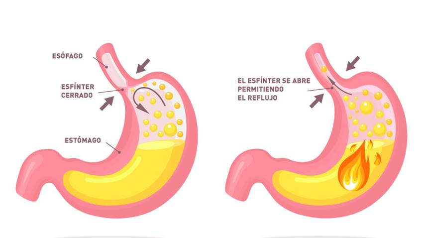 Reflujo ácido y reflujo gastroesofágico: ¿son lo mismo?