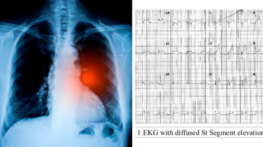 Dolor de pecho en joven de 22 años culmina con diagnóstico de cáncer de pulmón