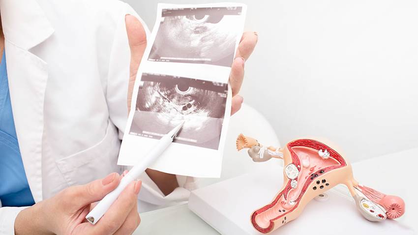 Cómo pueden afectar los desequilibrios hormonales al útero