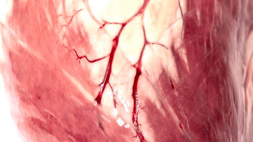 Riesgo cardiovascular en pacientes con hígado graso no alcohólico