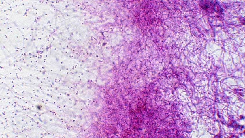 La penicilina reduce significativamente la progresión de la cardiopatía reumática en los niños