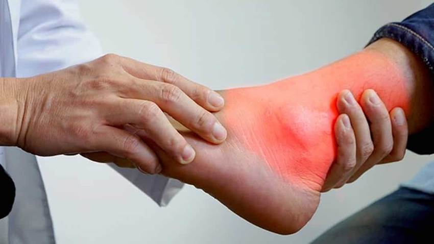 La relación entre la gota y comorbilidades es independiente de los niveles de ácido úrico