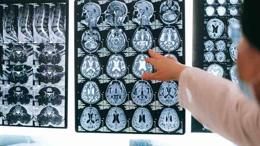 Médicos e ingenieros desarrollan primer catéter dirigible para la cirugía cerebral