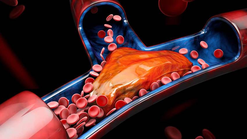 Trombosis venosa: hinchazón o enrojecimiento de la pierna como síntomas