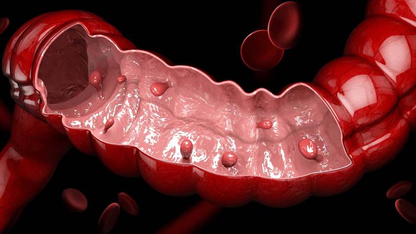 El consumo de antibióticos puede aumentar el riesgo de cáncer de colon