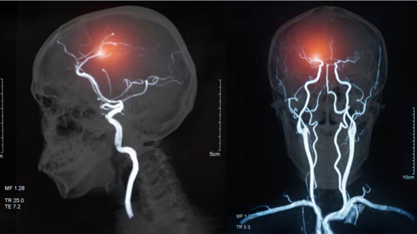 Nueva herramienta gratuita para predecir accidentes cerebrovasculares