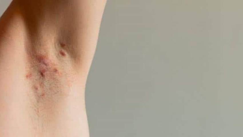 Vital el historial familiar en pacientes con Hidradenitis Supurativa