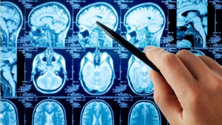 Complicaciones neurológicas después de las vacunas son menores frente al impacto del COVID-19