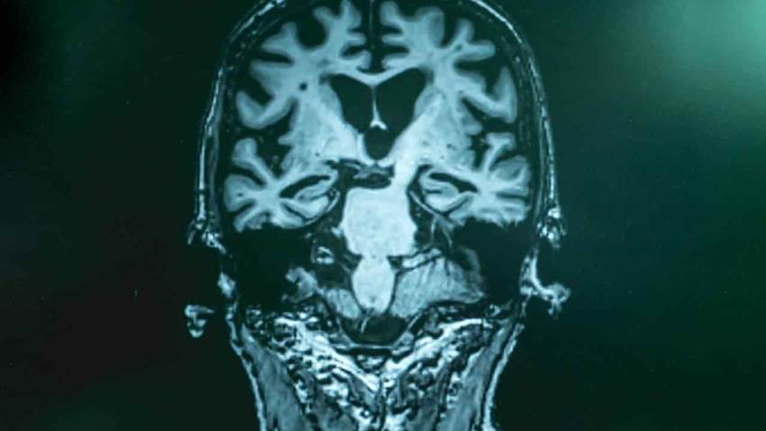 Nuevo biomarcador en sangre serviría para detectar la enfermedad de Alzheimer en sus fases iniciales