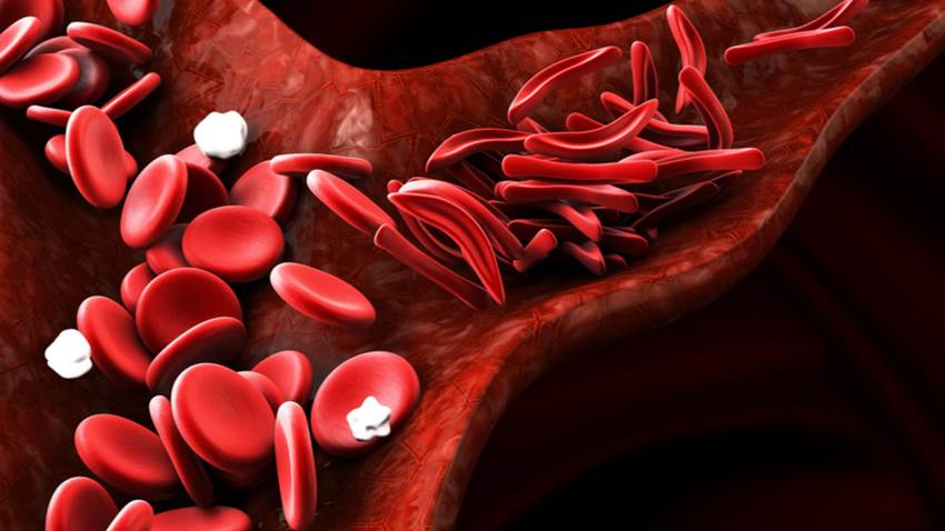 Anemia falciforme es el diagnóstico de mayor prevalencia entre las enfermedades raras en Puerto Rico