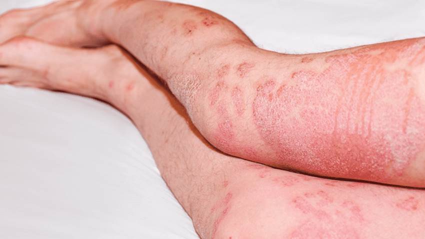 5 claves para el cuidado de la piel de los pacientes con artritis psoriásica