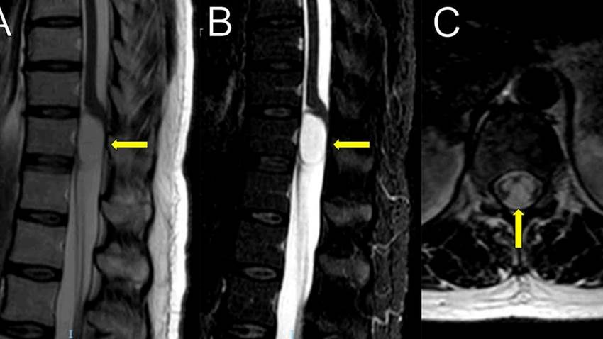 Laminectomía bilateral con durotomía como tratamiento para pacientes con quistes en la columna vertebral