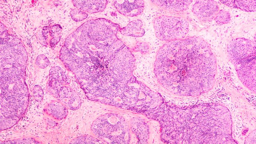 Verzenio® Significantly Reduced the Risk of Cancer Recurrence by 25% for People with HR+, HER2- High Risk Early Breast Cancer