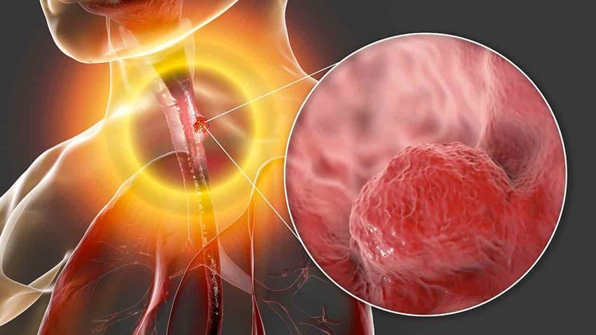 Tratamiento contra el reflujo reduce el cáncer de esófago