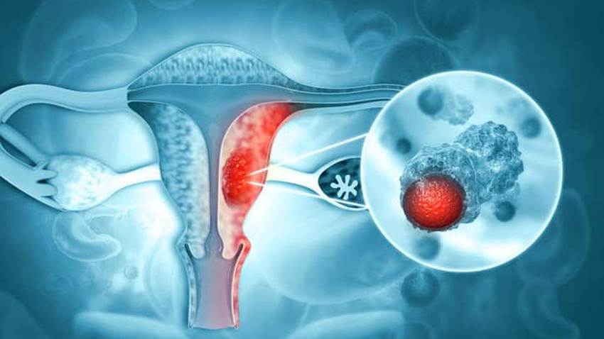 Fármaco para el asma complementaría el tratamiento de cáncer de ovario al superar barreras inmunitarias