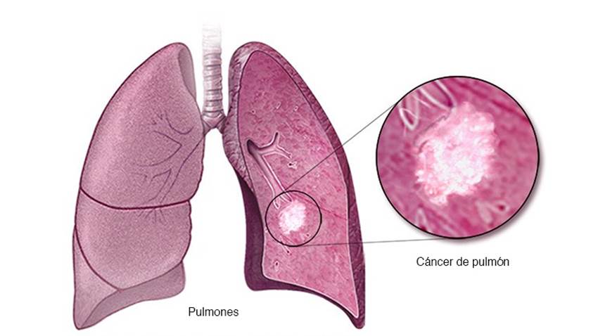 Cáncer de pulmón:  patología originada en gran proporción por malos hábitos conductuales