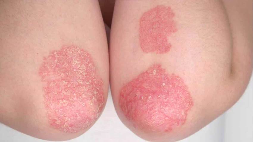 Medicamento RINVOQ recibe aprobación de la FDA de los EE.UU. para artritis psoriásica activa