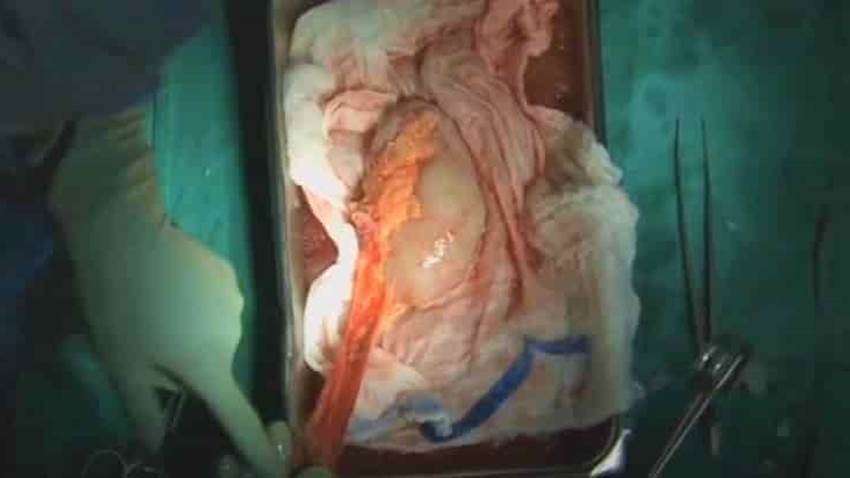 Trasplante de riñón e hígado en adultos con VIH arroja buenos resultados a largo plazo