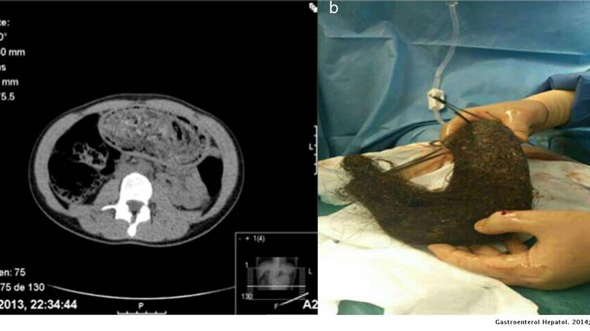Bebé de dos años, con antecedentes de anemia, presenta rara bola de pelo en tracto gastrointestinal