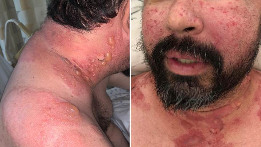 Descubren rara variante de lupus eritematoso sistémico bulloso en paciente puertorriqueño