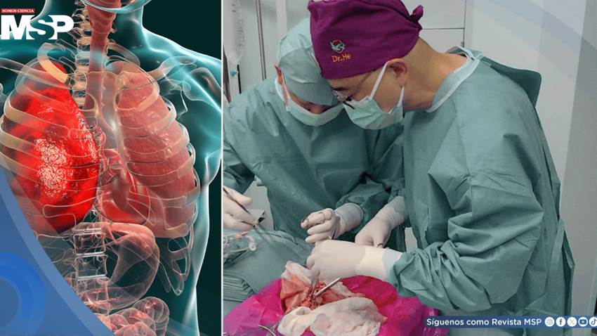 Logran el primer trasplante de pulmón de cerdo modificado genéticamente a un humano