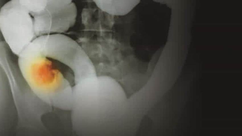 El cáncer colorrectal es una enfermedad más común en hombres y aumenta el riesgo a partir de los 50 años