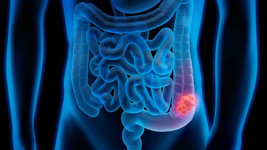 Mini-examen clínico: ¿Cuánto sabe sobre la colitis ulcerosa?