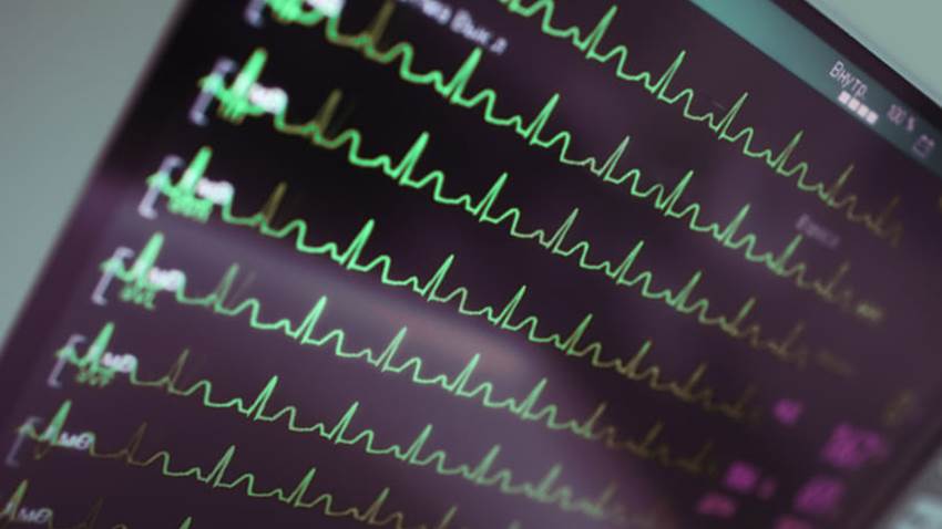 Cómo utilizar la radioterapia para curar arritmias en el corazón