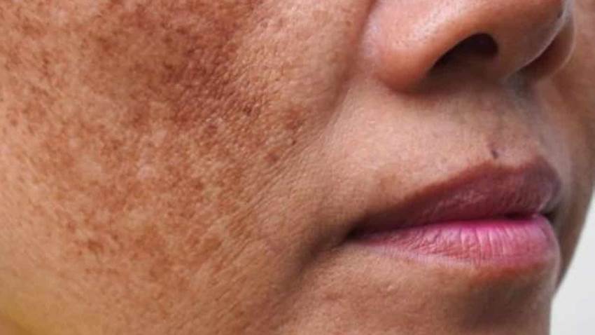 Estudio revela que la micropunción es un complemento eficaz de los tratamientos tópicos contra el melasma