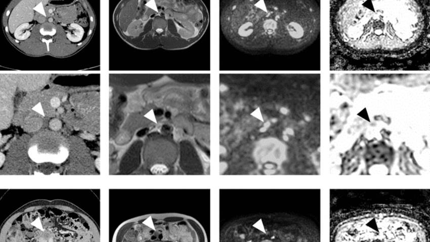 La resonancia magnética reemplazaría a la tomografía computarizada para detectar el Cáncer Testicular