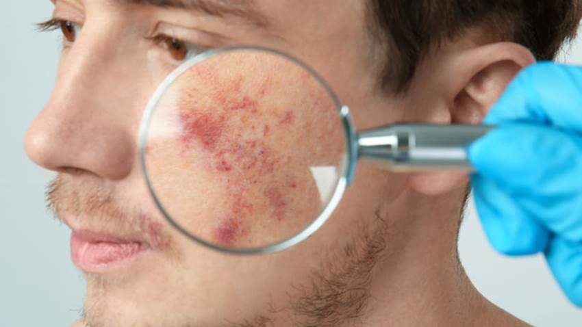 Dermatitis atópica: trastorno que va más allá de una patología cutánea
