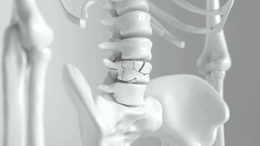 Los suplementos de calcio y vitamina D no evitan fracturas de huesos