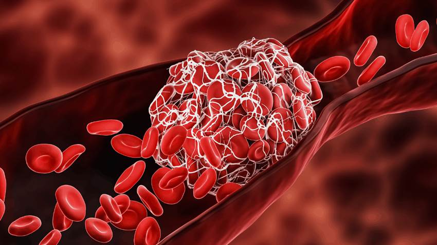 Paciente puertorriqueño desarrolla rara tríada de trombocitopenia y fallo renal