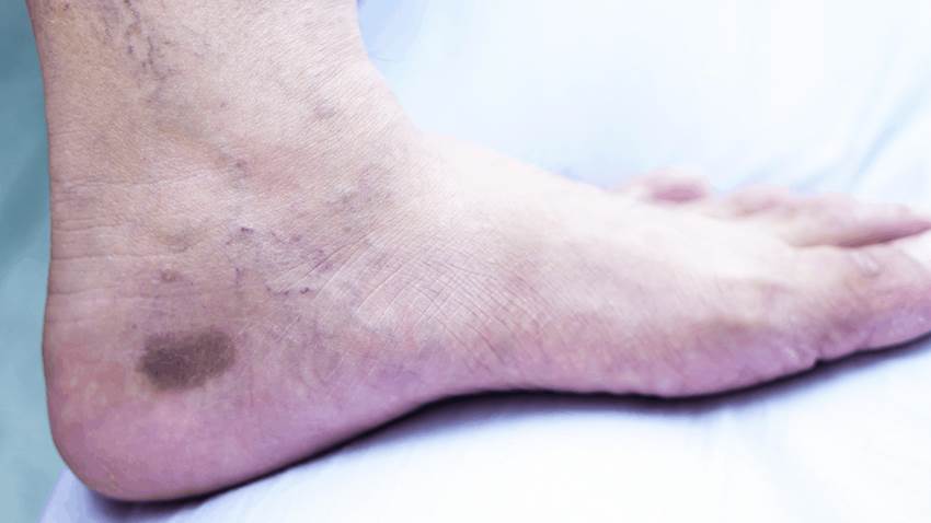 Cómo mejorar la mala circulación de las piernas y los pies