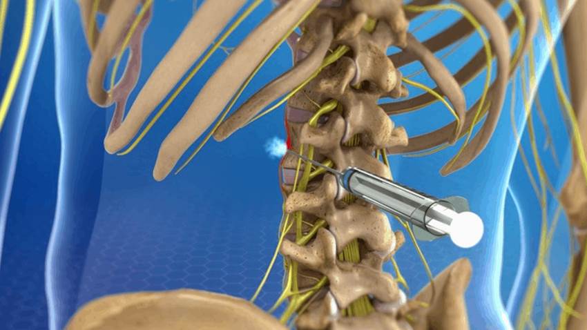 Cuestionan la utilidad de los bloqueos paravertebrales como tratamiento del dolor crónico
