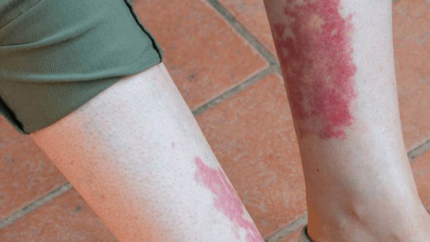 Vasculitis: Nuevas guías para tratar seis formas de la enfermedad