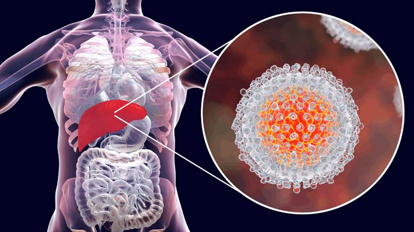Identificar a tiempo la hepatitis C evita el desarrollo irreversible de la cirrosis