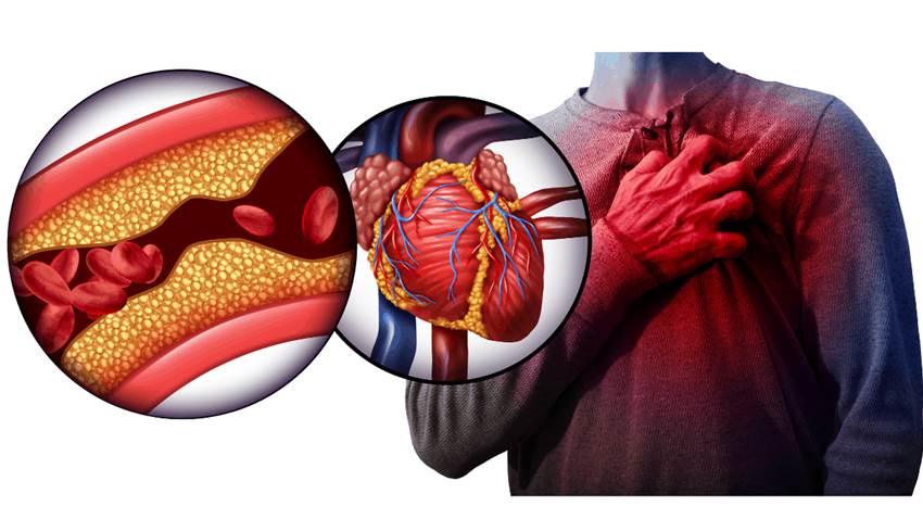 Señales de alarma de un infarto de Miocardio
