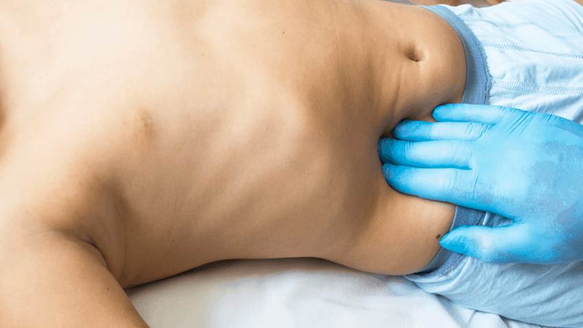 Apendicitis: primeros síntomas y señales de advertencia