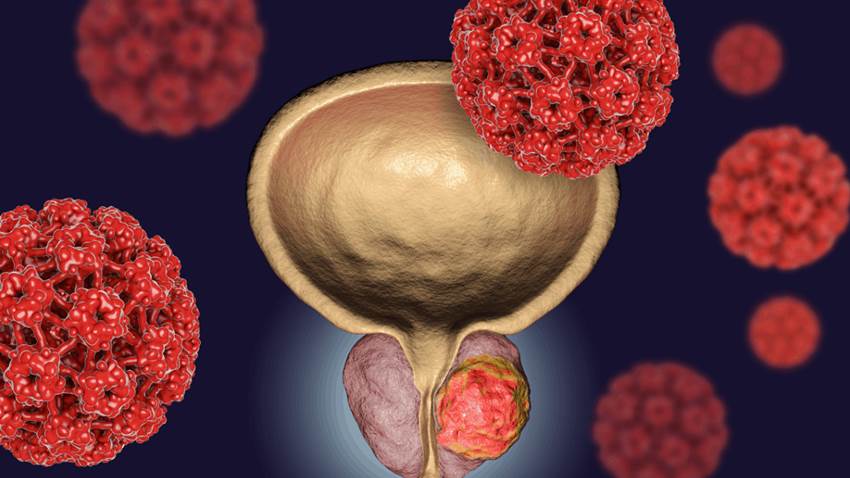 Presentan nueva herramienta de inteligencia artificial para la detección precoz del cáncer de próstata