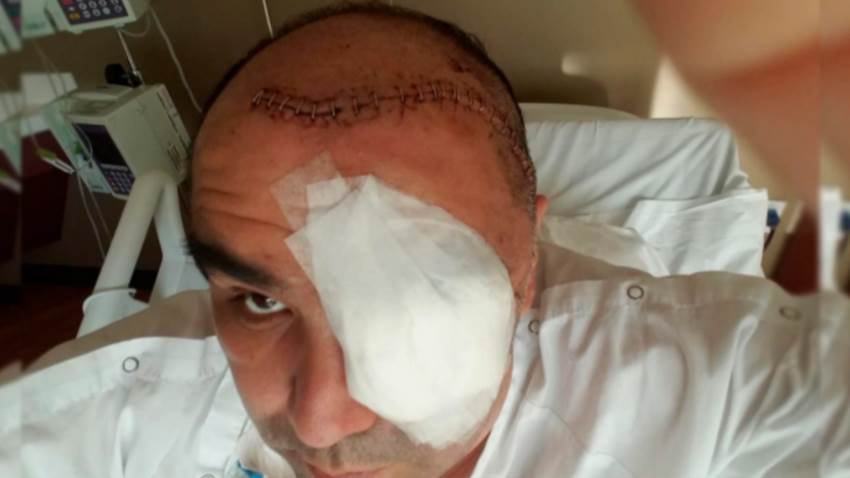 Hongo negro: la infección asociada al coronavirus que avanza con sigilo en México