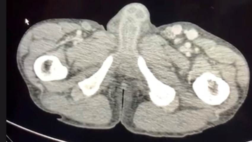 Hallan rara infección bacteriana por Bartonella en paciente severamente comprometido con VIH